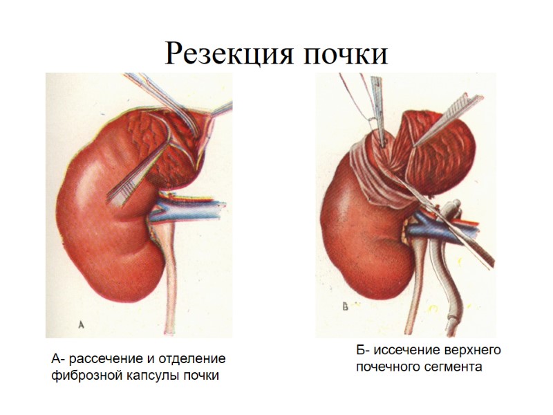 Резекция почки Б- иссечение верхнего  почечного сегмента А- рассечение и отделение  фиброзной